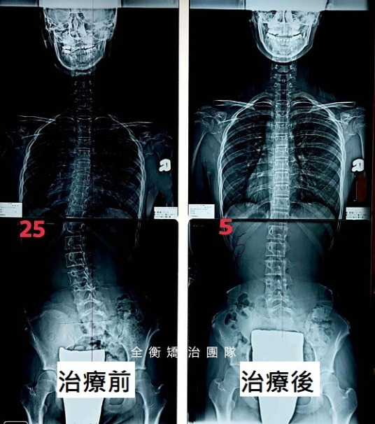 側 彎 症 脊柱 脊柱側彎症之治療 通論