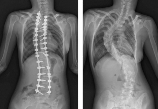 重度脊椎側彎開刀
