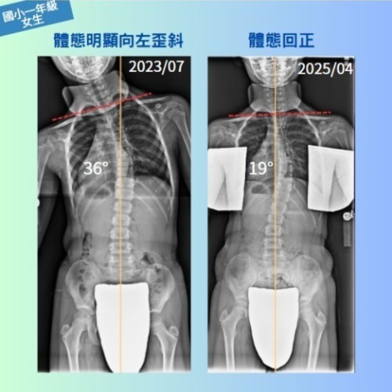 幼童側彎