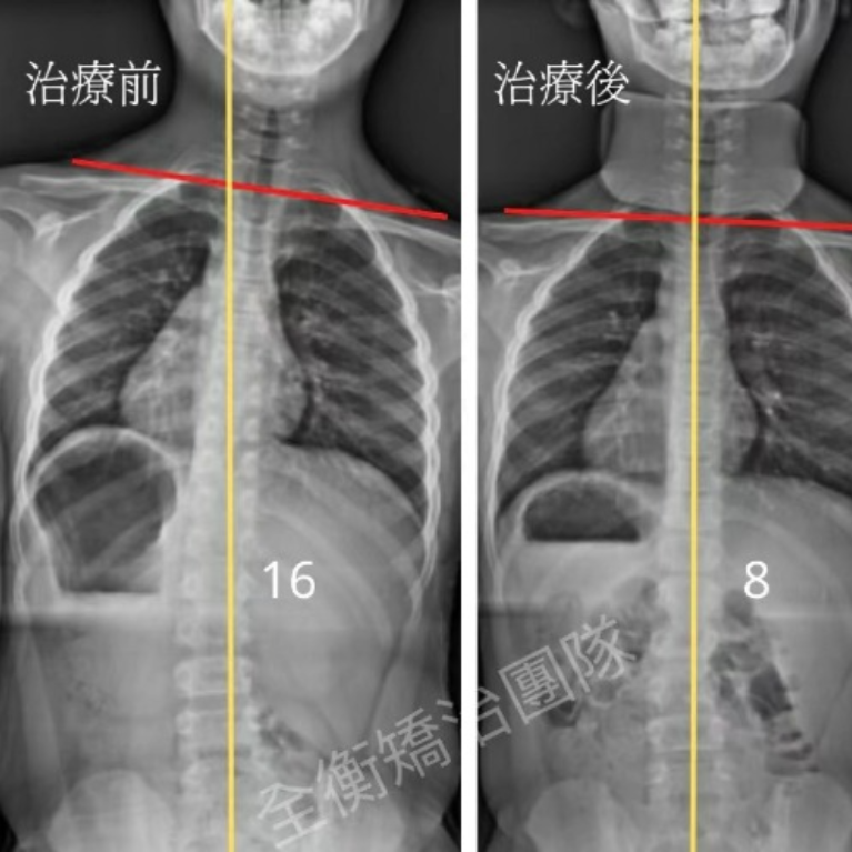 青少年 功能性側彎