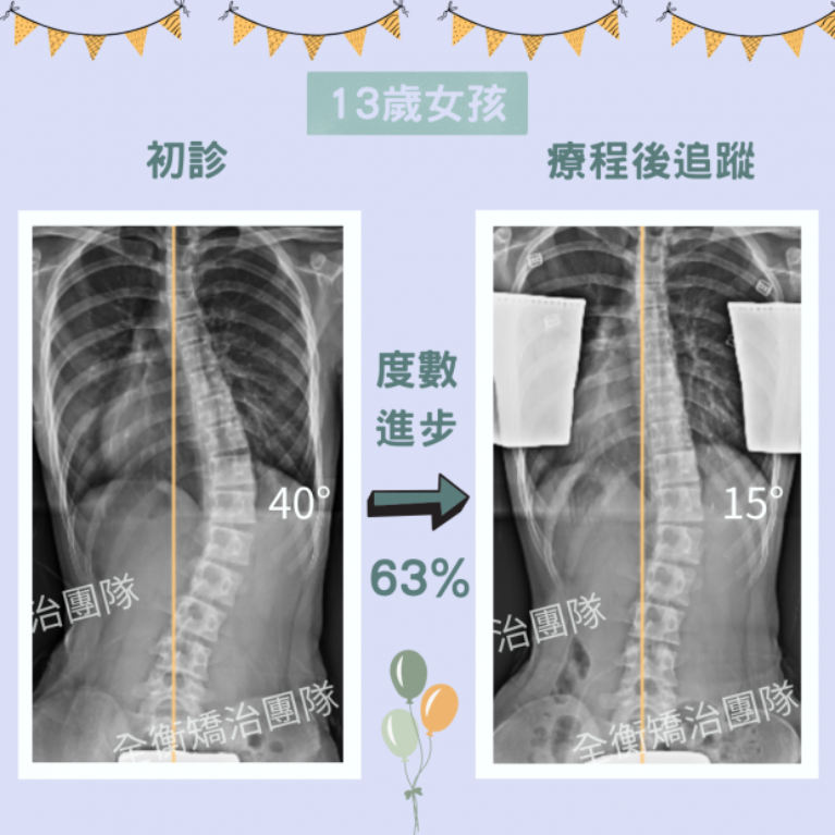 青少年 大側彎度數