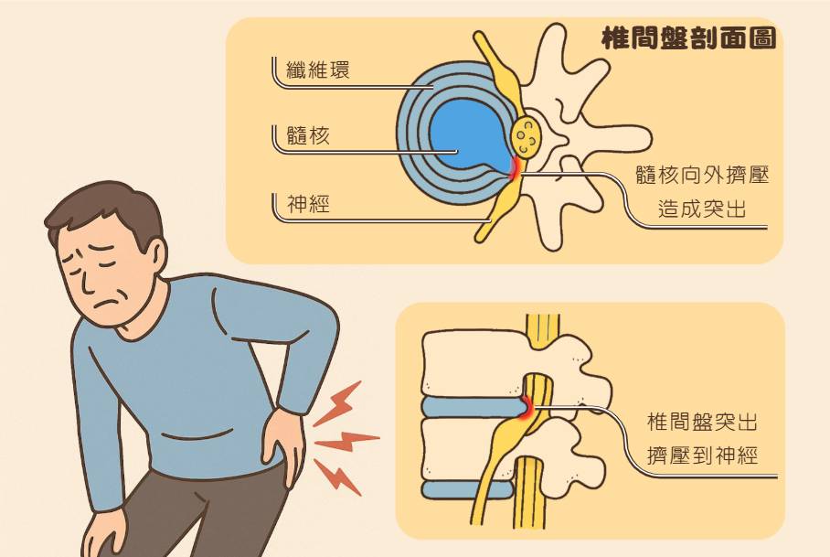 椎間盤突出 衡觀診所