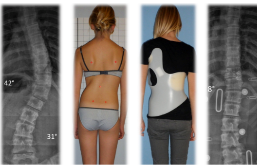 施羅斯側彎背架