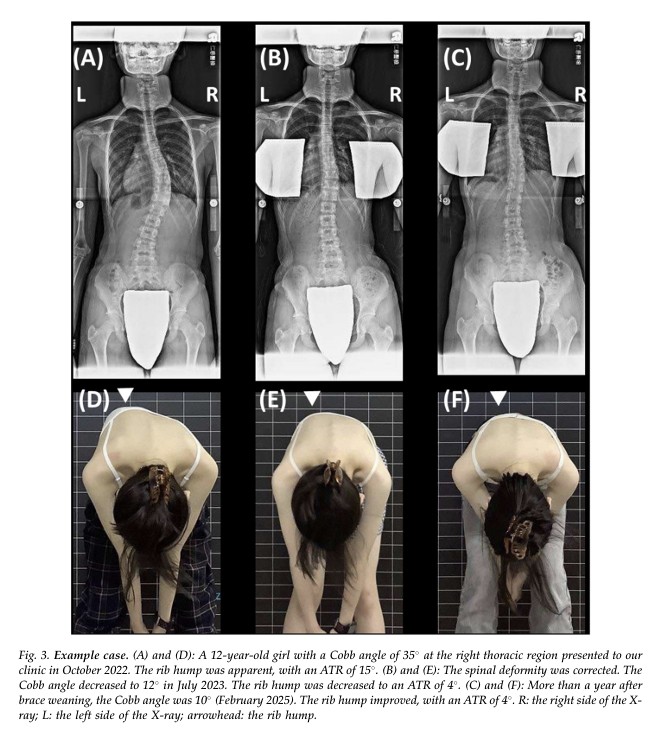 衡觀診所 青少年非手術矯正 研究論文
