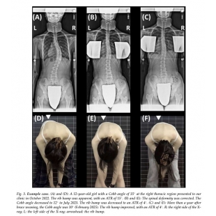 衡觀診所 青少年非手術矯正 研究論文.jpg