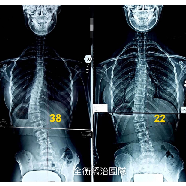 14歲脊椎側彎38度女孩 - 成果分享 - 汪作良醫師 衡觀診所