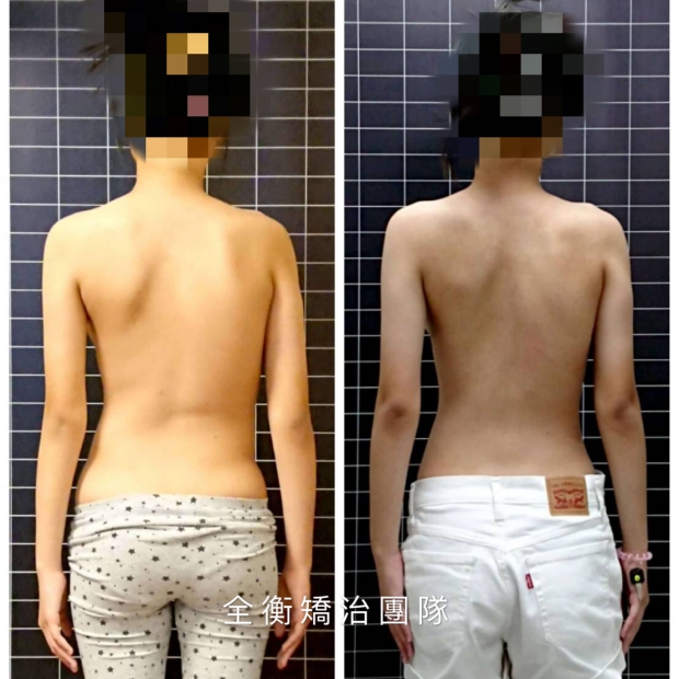 脊椎側彎案例分享.jpg 脊椎側彎案例分享.jpg