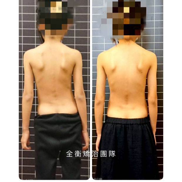 脊椎側彎案例分享.jpg 脊椎側彎案例分享.jpg