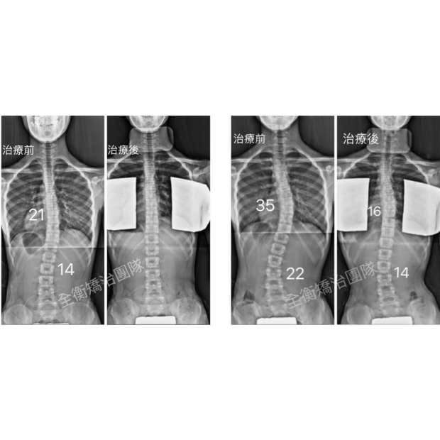 脊椎側彎X光.png