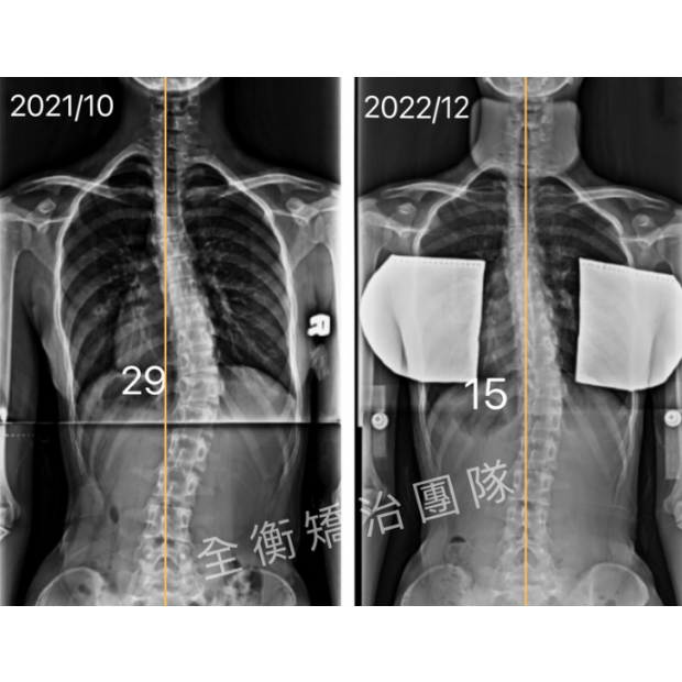 脊椎側彎矯正 X光對比.png