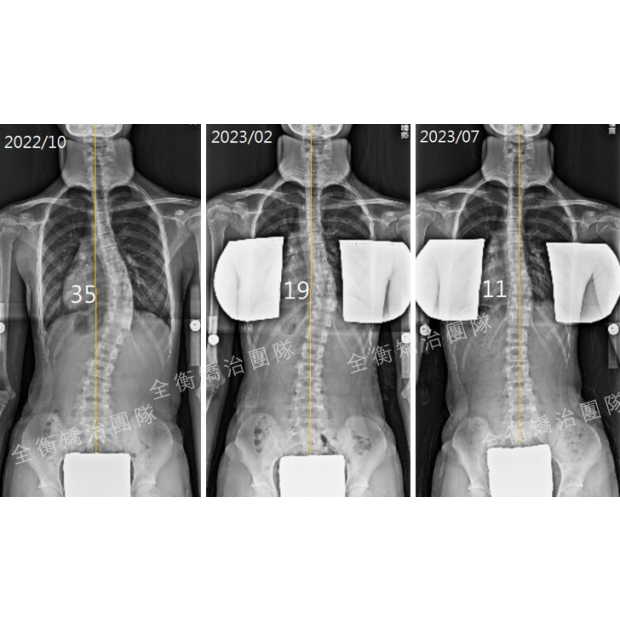 8個月X光對比.png