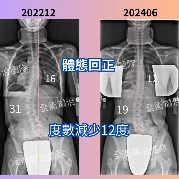 10歲側彎女孩案例.jpg