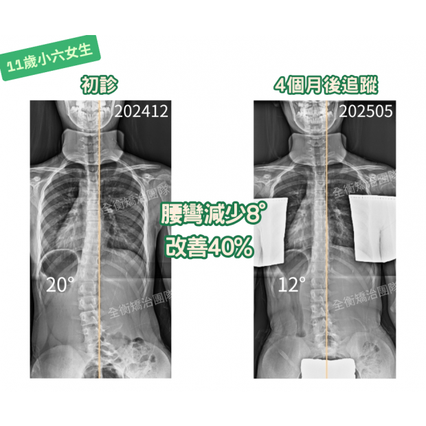 11歲20度女生 矯治4個月進步 40_.png