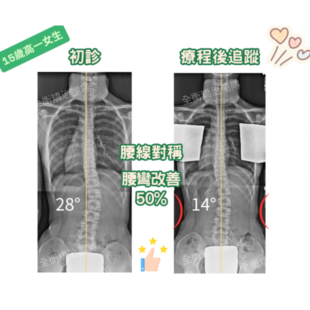 15歲女生脊椎側彎矯正7062.png