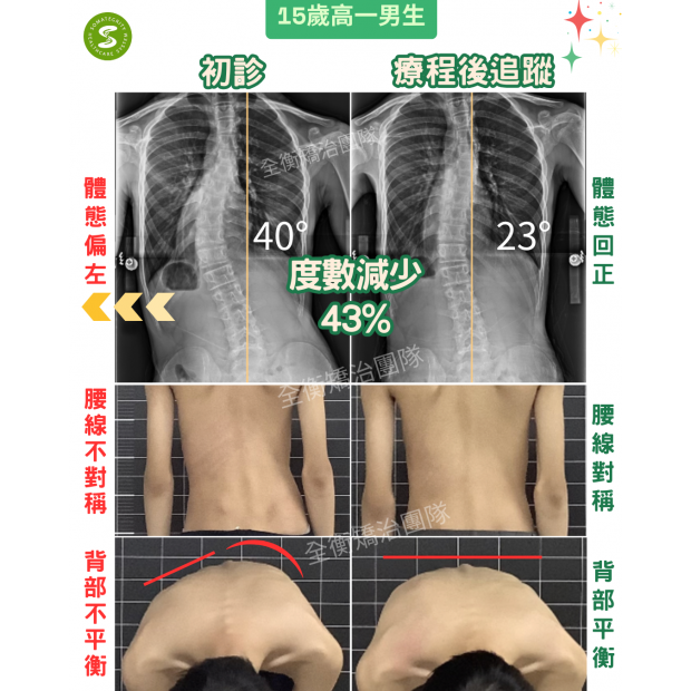 15歲高一側彎40度男生 矯正案例 7898.png 15歲高一側彎40度男生 矯正案例 7898.png
