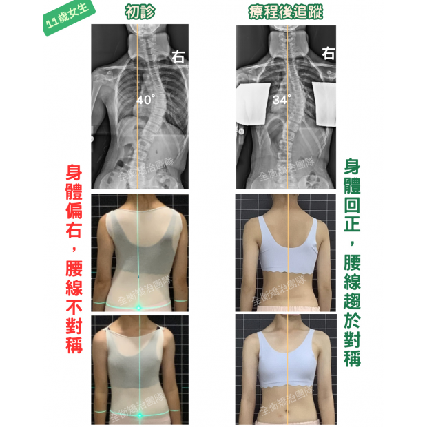 scoliosis case.png scoliosis case.png