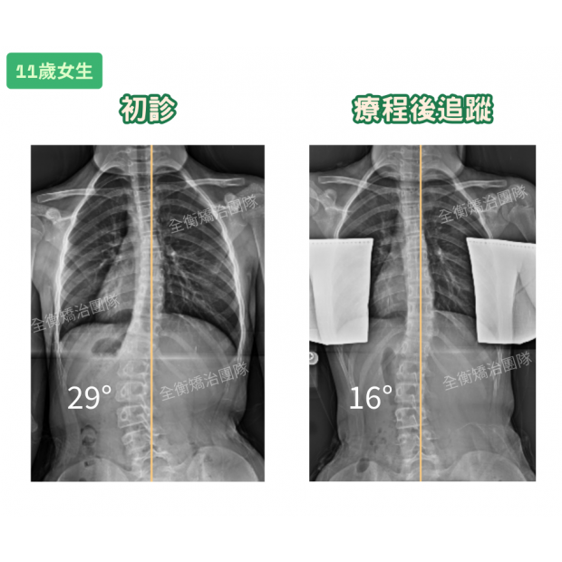 7644衡觀診所 11歲側彎女生 案例分享 _1_.png