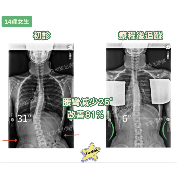 7041  14歲側彎女生.png