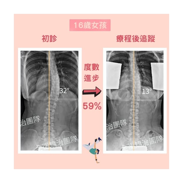 07027 16歲脊椎側彎女生 案例分享 衡觀診所