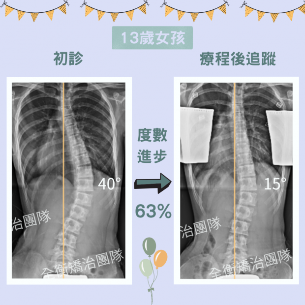 7126 13歲脊椎側彎案例分享.png