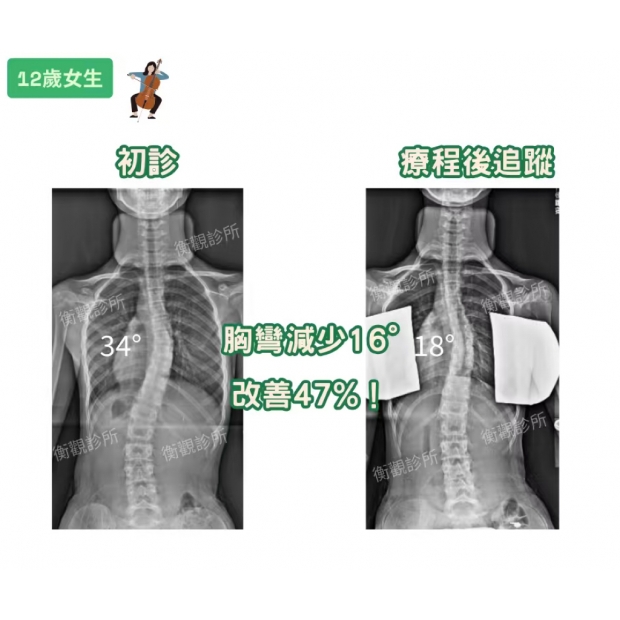 衡觀診所 脊椎側彎 案例分享 12歲胸彎34度女生.jpg