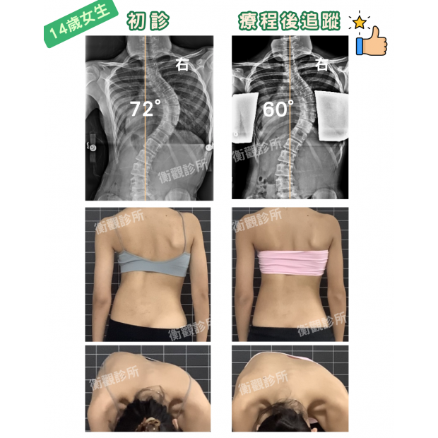 14歲72度側彎女生 案例分享.png