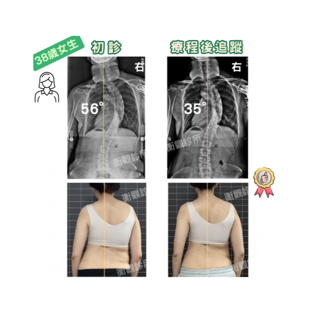 成年人側彎 案例分享.png