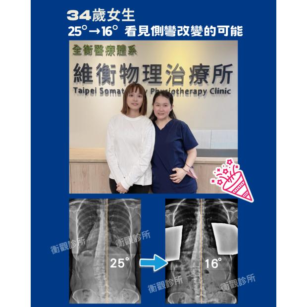 脊椎側彎矯正 案例分享.png