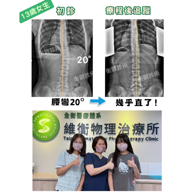 衡觀診所 13歲女孩 腰椎側彎矯正  案例分享.png