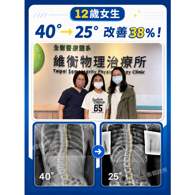 衡觀診所 12歲女生 8257側彎矯正案例分享.png
