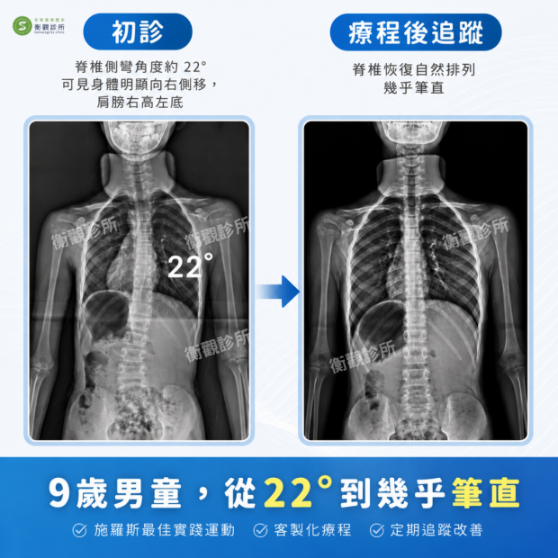 衡觀診所：32歲成人側彎女生，真實分享.png