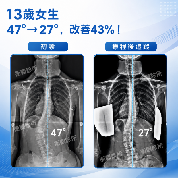 衡觀診所 13歲女生 腰彎47度  側彎矯正案例分享.png
