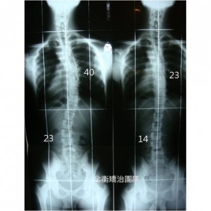 20歲成人側彎成果分享.jpg