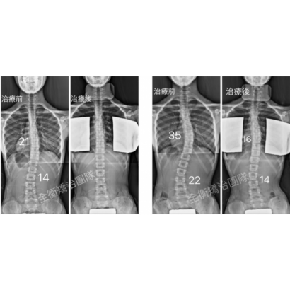 脊椎側彎X光.png
