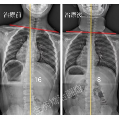 脊椎側彎X光對比.jpg