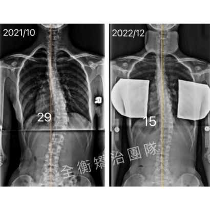 脊椎側彎矯正 X光對比.png