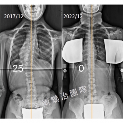 脊椎側彎矯治X光對比.jpg