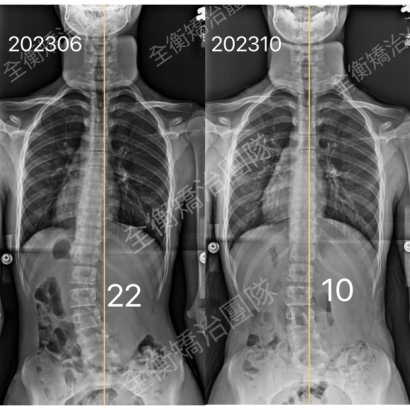 側彎矯正 X光對比.jpg