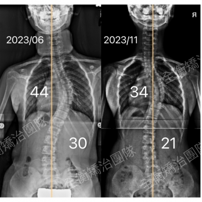 重度脊椎側彎矯正 X光對比.jpg