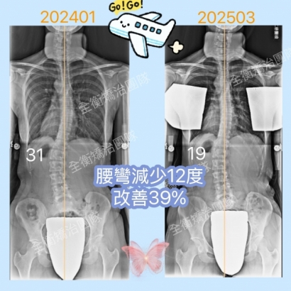 成年側彎案例.jpg