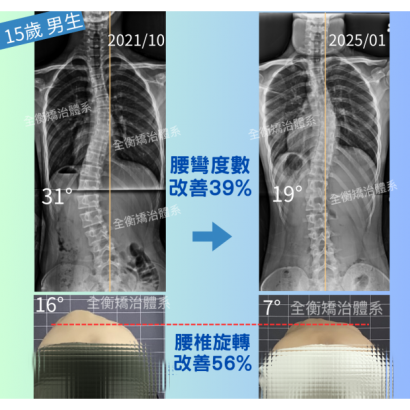 側彎對比.png