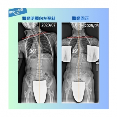 6歲側彎孩子案例分享.jpg