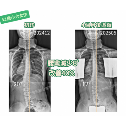 11歲20度女生 矯治4個月進步 40_.png 11歲20度女生 矯治4個月進步 40_.png
