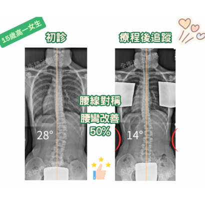 15歲女生脊椎側彎矯正.png