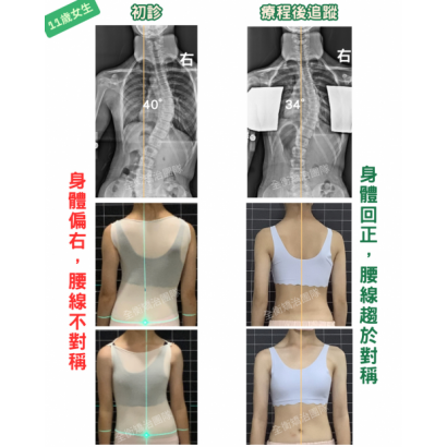 scoliosis case.png