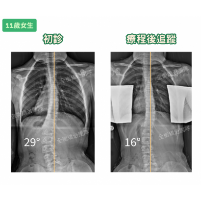 7644衡觀診所 11歲側彎女生 案例分享 _1_.png