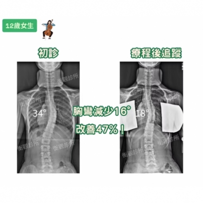 衡觀診所 脊椎側彎 案例分享 12歲胸彎34度女生.jpg