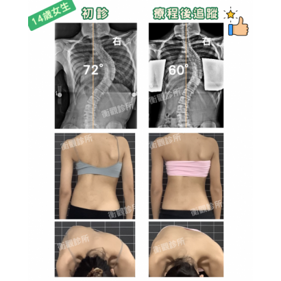 14歲72度側彎女生 案例分享.png