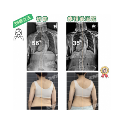 成年人側彎 案例分享.png