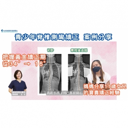 11歲女孩側彎矯正案例分享 34°→16°-封面.jpg